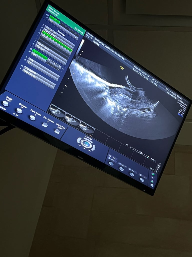 infertility fertility IVF stories
